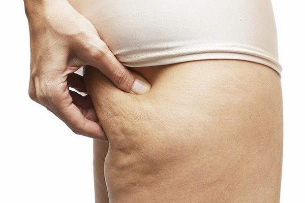 Mỡ đùi - “Thủ phạm đáng ghét” khiến chị em ngại diện những chiếc váy xinh