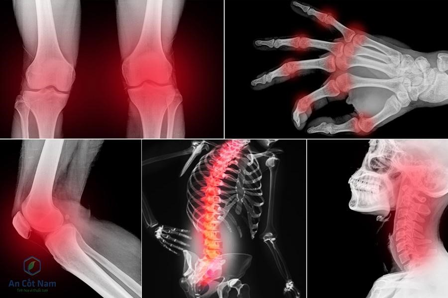 Bài thuốc trị đau nhức xương khớp nào hiệu quả và tốt nhất hiện nay?